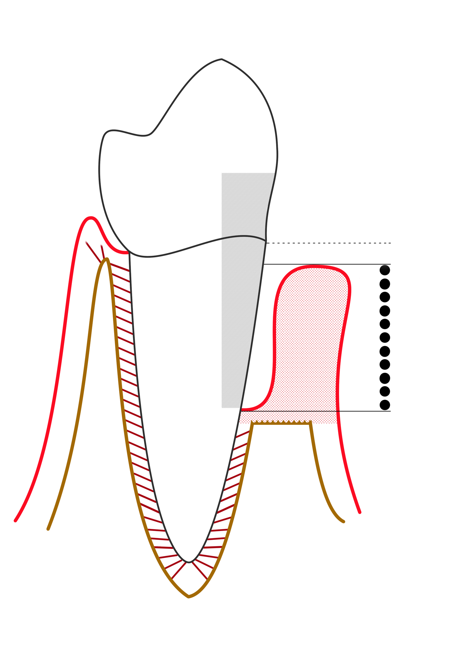 Diagram of a tooth showing the gingiva, periodontal ligament, and bone, with a periodontal probe measuring pocket depth in advanced periodontitis