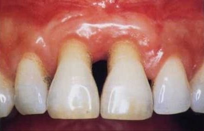 Clinical photograph of gingival recession on the upper front teeth, with exposed root surfaces and an inflamed gum margin