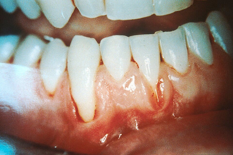 Localised gum recession on the lower front teeth caused by smokeless tobacco held against the gum
