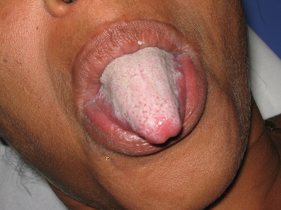 Close-up of a human tongue with a thick greyish-white coating covering the dorsal surface